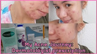 My Acne Journey Lymecycline Capsules Epiduo Gel Dermol 500 amp Cetraben Lotion  Gel Pines [upl. by Raybin]