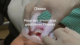 Aligneurs Cheeez  Pose des premières gouttières dalignement [upl. by Porte]