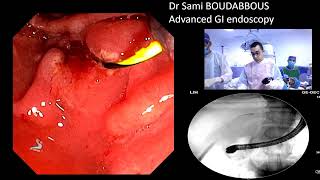 ERCP FOR BILIARY FISTULA AFTER LAPAROSCOPIC CHOLECYSTECTOMY [upl. by Lind]