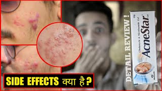 AcneStar Gel Honest Review  Side Effects Its Work Or Not Usage  Hindi [upl. by Sharity]