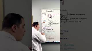 Ischemic Stroke  Lacunar Infarct shorts [upl. by Ennahteb]