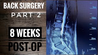 Back Surgery L4L5 Laminectomy Recovery part 2 [upl. by Durwyn232]