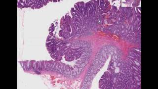 Histopathology Colon Tubular adenoma adenomatous polyp [upl. by Wilhelmina]