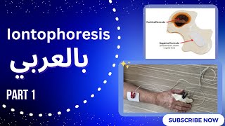 Iontophoresis بالعربي [upl. by Tybald349]