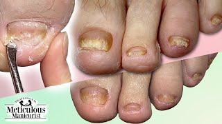 CUTICLE Cleaning on FUNGAL TOENAILS Transformation [upl. by Rohpotsirhc]