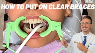 How to put Clear Braces on  Close up view  Ceramic Braces [upl. by Ailuy629]