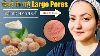 In 7 Days💕 चेहरे के पुराने गड्ढे DEEP ACNE SCARS LARGE PORES को जड़ से ठीक करें इस Remedy से [upl. by Chipman]