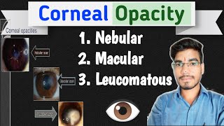 Corneal Opacity  The Cornea  MKSharma Ophthalmic Education Ophthalmology [upl. by Kcarb407]