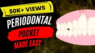 Periodontal disease  Periodontal pocket [upl. by Sibyls]