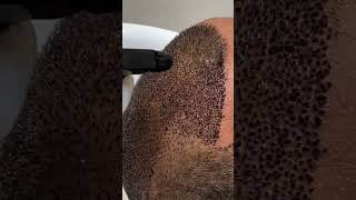 First Hair Wash After Hair Transplant Expert Tips  Dadu Medical Centre [upl. by Ahsenar377]