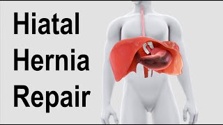 Hiatal Hernia Repair Animation [upl. by Anselmi83]