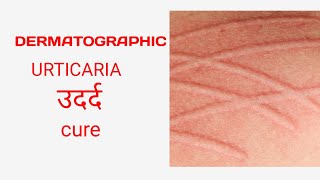 Dermatographic urticaria treatment urticaria ayurveda [upl. by Hach147]