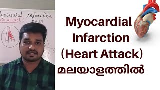 Heart AttackMyocardial Infarction in Malayalam [upl. by Aenehs43]