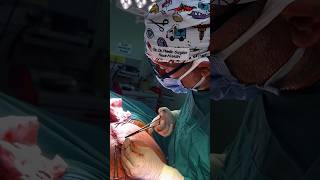 Closing up a “T” Tummy Tuck shorts plasticsurgery plasticsurgeon stitching turkey istanbul [upl. by Abey]