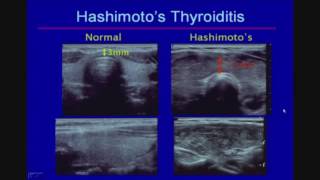 Sonographic Evaluation of Diffuse Thyroid Disease [upl. by Sorenson692]