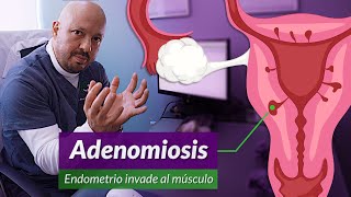 Cirugía por Adenomiosis Y diferencia con miomas y endometriosis [upl. by Annatnom622]