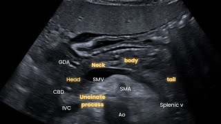 Ultrasound Abdomen Part 1 Pancreas How I do it Case study uncinate process neoplasm [upl. by Malchy]