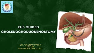 Endoscopic Ultrasound Guided Choledochoduodenostomy  PeriAmpullary Carcinoma  EUSBD [upl. by Kronick691]