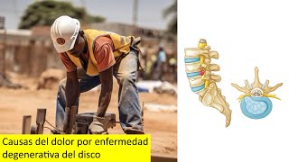 Causas del dolor por enfermedad degenerativa del disco [upl. by Enilesor125]