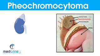 Pheochromocytoma causespathophysiologysymptoms and treatment [upl. by Christine]