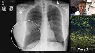 Isolation tutorial Chest xray with Andrew Dixon [upl. by Herzel]