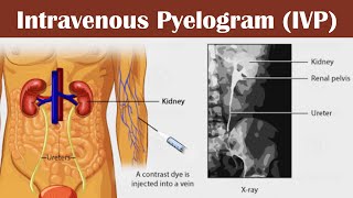 Intravenous pyelogram IVP [upl. by Tyrus]