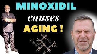 Minoxidil for Hair Loss  Side Effects [upl. by Etteneg]