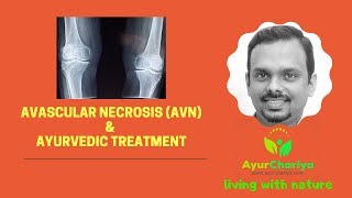 Avascular Necrosis or AVN amp Ayurvedic Treatment avascular necrosis of hip treatment in hindi [upl. by Strong]