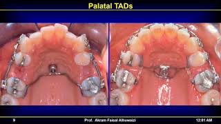 TADs 2018 Part 7 Onplants and plates Live in Arabic [upl. by Assirrem179]