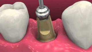 Restoring BioHorizons Dental Implants 2011 [upl. by Lrat]