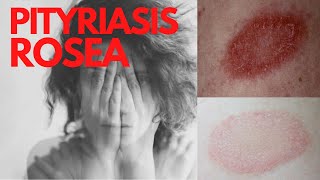 PITYRIASIS ROSEA  Answers of the common questions about Pityriasis Rosea What is Pityriasis rosea [upl. by Dracir]