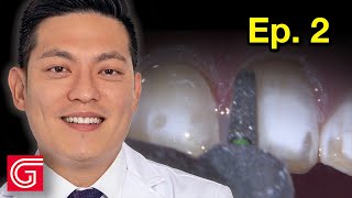 How To Prepare ANTERIOR Teeth With ENAMEL Hypoplasia  Ep 2 [upl. by Cailly211]