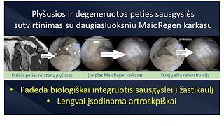 Artroskopinis biologinio karkaso įterpimas rotator cuff repair with MaioRegen augmentation [upl. by Adlig]