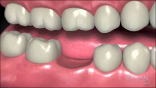 Dental Implants  Why You Should Have One [upl. by Drofwarc]