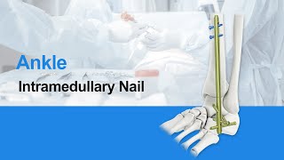 CZMEDITECHHindfoot Fusion Ankle Nail Orthopedics Implants Intramedullary nail [upl. by Atiuqat]