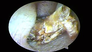 Remove two large cerumen plugs and dry fungus pieces from the ears and clean them（20241025） [upl. by Notsgnal]