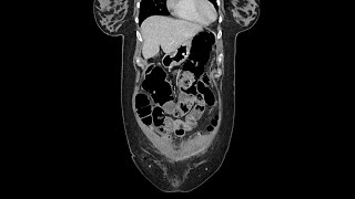 Pseudo obstruction of bowels  Ogilvie syndrome [upl. by Blessington]