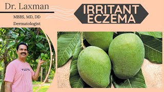 Irritant Dermatitis  Irritant Eczema  How To Cure Eczema  How To Cure Allergy  Types Of Eczema [upl. by Esydnac]