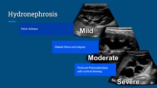 Hydronephrosis Ultrasound [upl. by Nifares341]