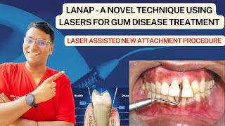 Dr Rudra Mohan  Laser Assisted New Attachment Procedure LANAP Technique for treating Gum Disease [upl. by Htebsil139]