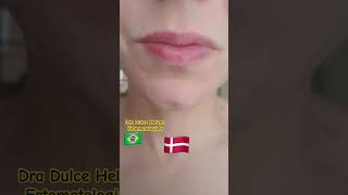 Queilite esfoliativa antes e depois Exfoliative cheilitis before and after [upl. by Adebayo]