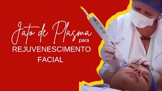 Jato de Plasma para Rejuvenescimento Facial [upl. by Frasier]