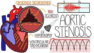 Aortic Stenosis Explained in 10 Minutes With Heart Murmur Sound [upl. by Jc967]