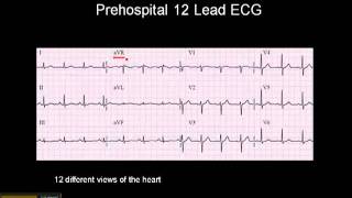 1215 Lead ECG The 12 Leads [upl. by Kcirdot394]