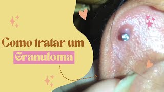 COMO TRATAR UM GRANULOMA NO PIERCING [upl. by Paulo]