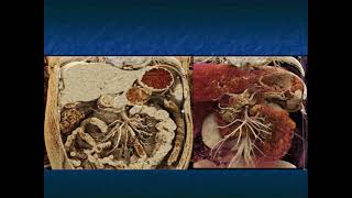 Mucinous Cystic Neoplasm of the Pancreas CT Appearance with Key Imaging Features  Part 1 [upl. by Raoul]