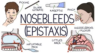 Understanding Nosebleeds Epistaxis [upl. by Coshow]