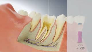 Achieving Patency with Bassi Logic  Conservative Endodontics [upl. by Releyks319]