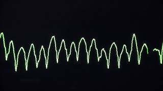 Cardiac arrest rhythms VF VT Asystole and PEA [upl. by Naired]