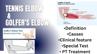 Tennis elbow amp Golfers elbow  Definition Causes Clinical features special test Pt management [upl. by Lindemann297]